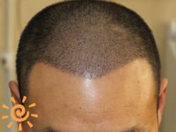 -大麦微针植发丨全国连锁