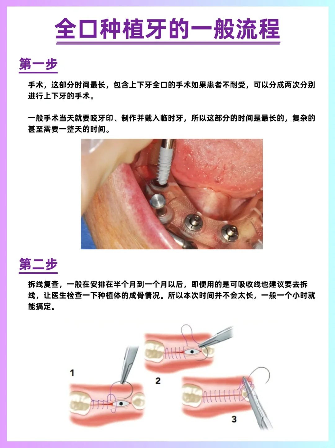 全口种植牙价钱图片