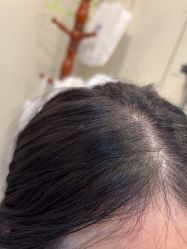 -碧莲盛·不剃发植发