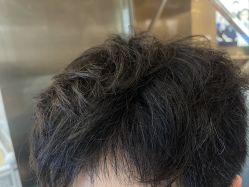 -碧莲盛·不剃发植发
