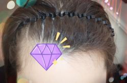 -大麦微针植发全国连锁