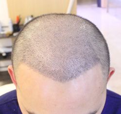 点击看大图 -大麦微针植发丨全国连锁