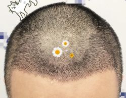 -大麦微针植发全国连锁