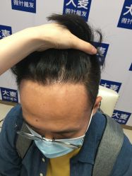 -大麦微针植发丨全国连锁