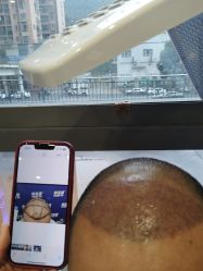 -碧莲盛·不剃发植发