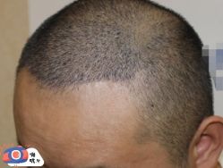 -大麦微针植发丨全国连锁