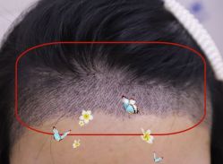 -大麦微针植发全国连锁