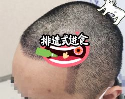 -大麦微针植发全国连锁