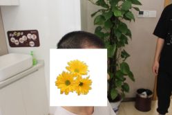 -大麦微针植发丨全国连锁