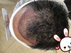 -大麦微针植发丨全国连锁