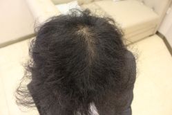 -大麦微针植发丨全国连锁