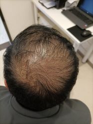 -大麦微针植发丨全国连锁