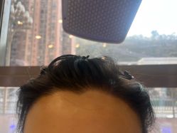 -碧莲盛·不剃发植发