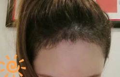 -大麦微针植发丨全国连锁