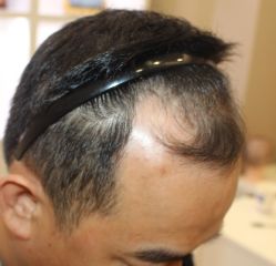 -大麦微针植发丨全国连锁