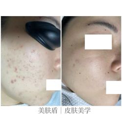 -美肤盾祛痘·问题肌头疗管理中心