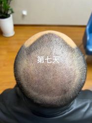 -大麦微针植发全国连锁