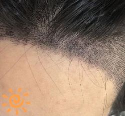 -大麦微针植发丨全国连锁