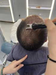 -大麦微针植发全国连锁