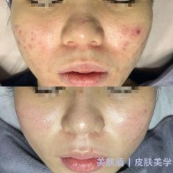 -美肤盾祛痘·问题肌头疗管理中心