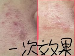 点击看大图 -苗医生0感科技祛痘