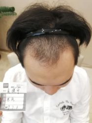 -大麦微针植发丨全国连锁