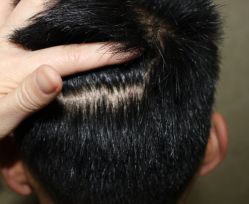 -大麦微针植发全国连锁