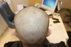 -大麦微针植发丨全国连锁