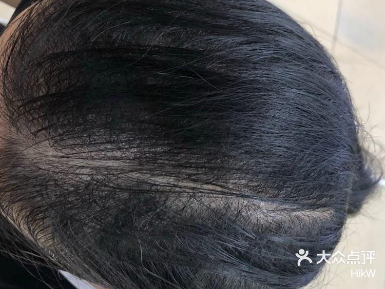 女性弥漫性脱发