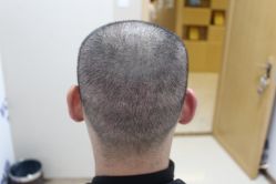 -大麦微针植发丨全国连锁