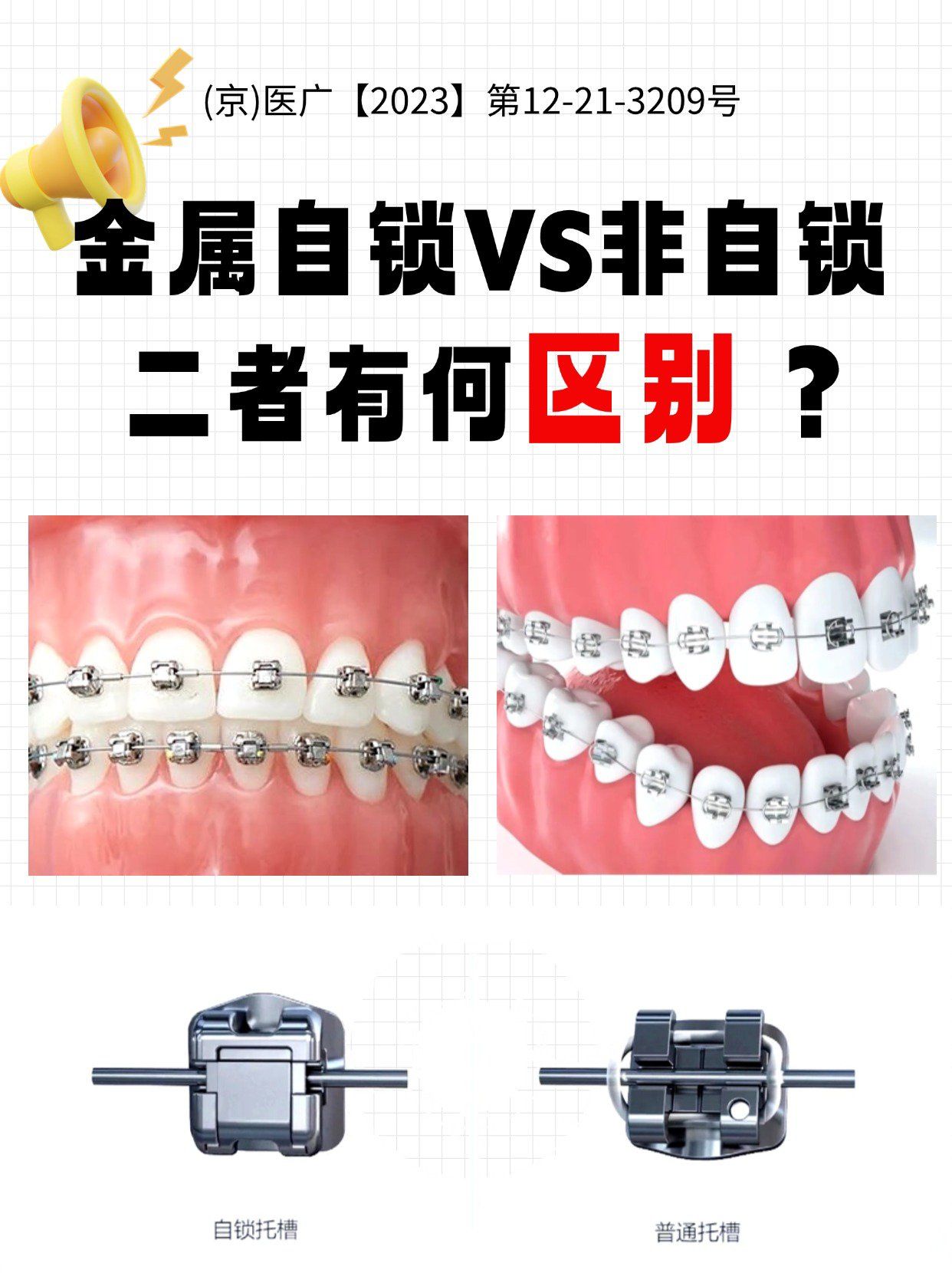 金属自锁vs非自锁,谁才是正畸界的高手?