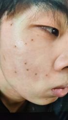 -北京美痣堂古方祛痣斑疣瘊