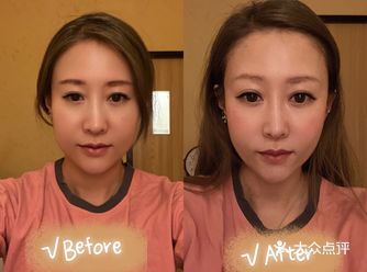 现在越来越多的明星都在做整骨瘦脸按摩了， 打针对于大