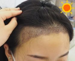 -大麦微针植发丨全国连锁