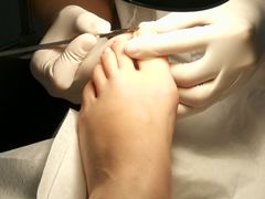 -世龙世家灰指甲鸡眼脚气甲沟炎跖疣护理(通州店)