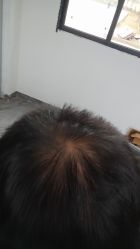 -碧莲盛·不剃发植发