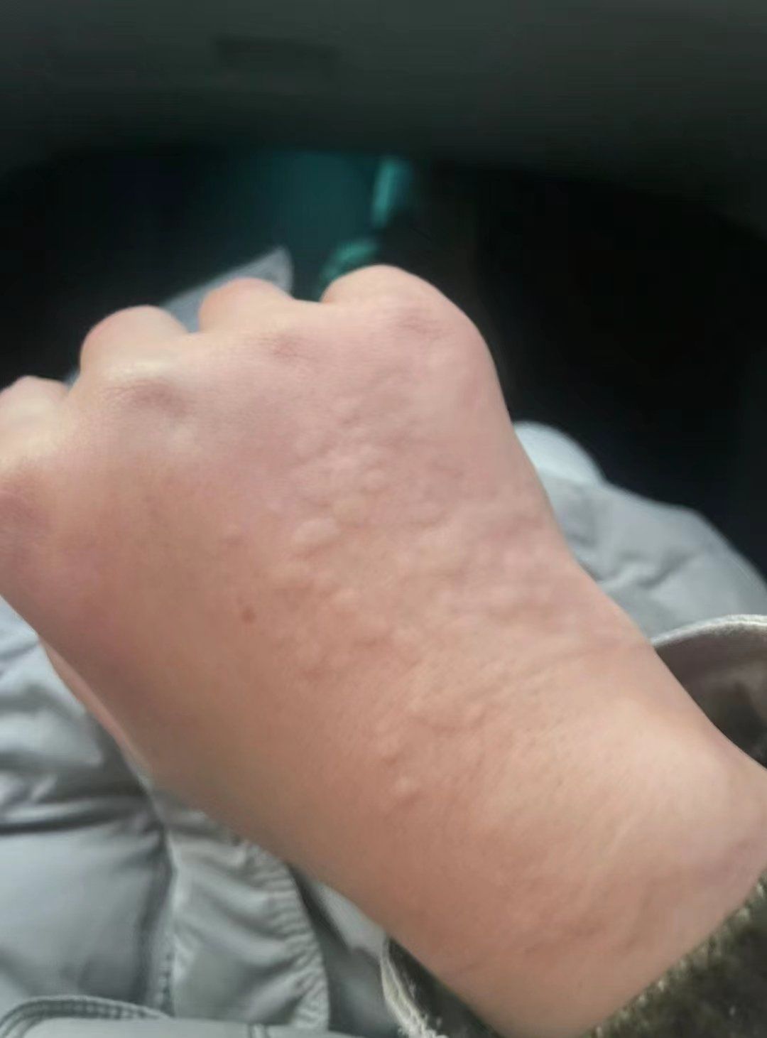 艾灸的特性刚好是排寒祛湿,做完后风团立马消失 .

有这种情况的