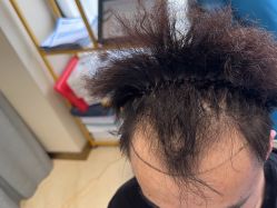 -碧莲盛·不剃发植发