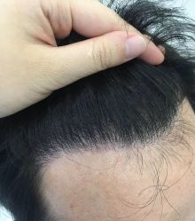 -大麦微针植发全国连锁