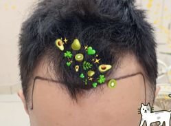 -大麦微针植发全国连锁