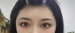 体验后-成都西区医院整形美容