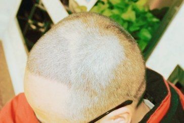 -大麦微针植发丨全国连锁