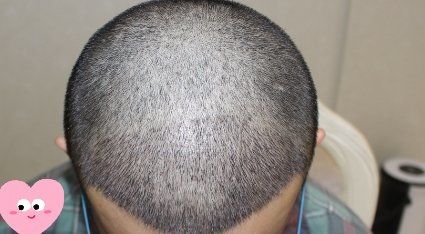 -大麦微针植发丨全国连锁