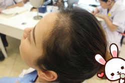 点击看大图 -大麦微针植发丨全国连锁