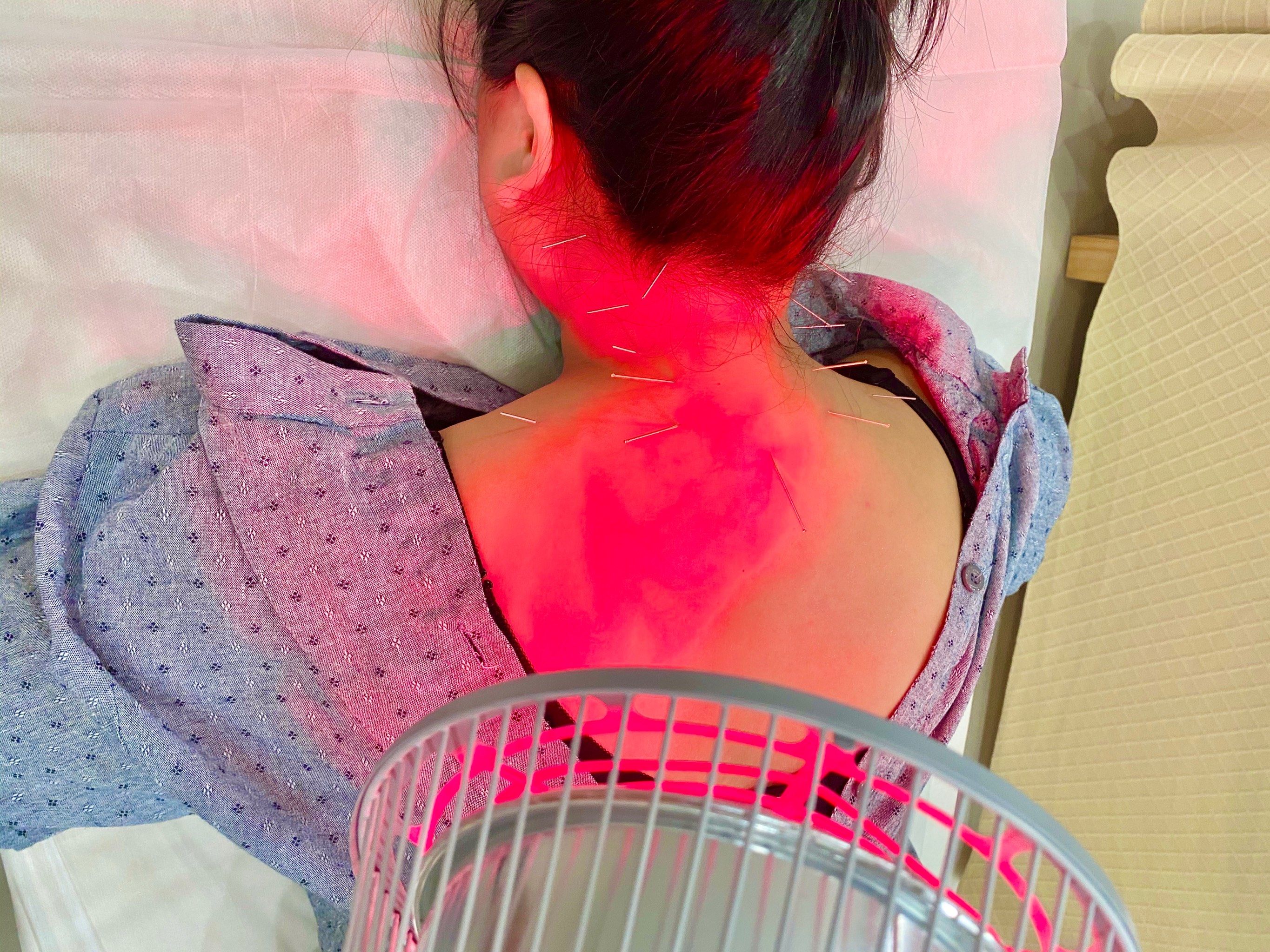 Châm cứu hỗ trợ giảm đau trong vật lý trị liệu cổ vai gáy