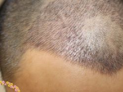 -大麦微针植发丨全国连锁