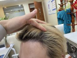 -碧莲盛·不剃发植发