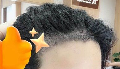 -大麦微针植发丨全国连锁