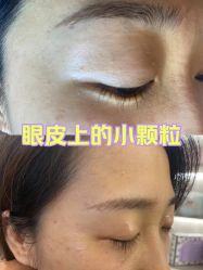 -美丽人生祛斑扁平疣汗管瘤中心