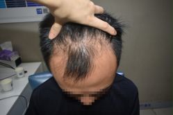 点击看大图 体验前-大麦微针植发全国连锁